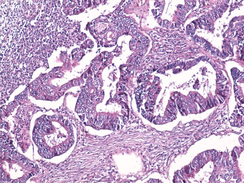 Pathological and immunohistochemical study of colon cancer. Evaluation ...