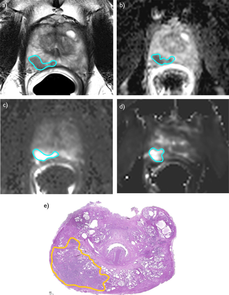 Digital prostate whole-mount specimen and mpMRI with Gleason Score 3 + 4 prostate cancer