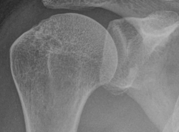 The Bony Bankart Lesion: How to Measure the Glenoid Bone Loss - PMC