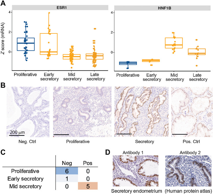 Figure 3. Validation of HNF1B expression in normal mid-secretory endometrium. A, Expression z-scores averaged from all probes for ESR1 and HNF1B on an external microarray-based dataset (GSE4888), validating expression of HNF1B in mid-to-late secretory phase. B, IHC staining of endometrium at various menstrual cycle phases for HNF1B. Control specimens used are tissues from endometrioid endometrial carcinoma (negative) and clear cell carcinoma of the ovary (positive) that have been previously described as being negative or positive for HNF1B (respectively). These were rerun in the same experimental lot as endometrium samples. Note that stromal cells further serve as internal negative control in the CCOC control specimen as staining is restricted to nuclei of tumor epithelium. C, Tabulation of HNF1B IHC results from a panel of 12 normal endometrium samples shows segregation by menstrual cycle phase. D, HNF1B IHC results from Human Protein Atlas, with two different antibodies, for two normal endometrium samples at the secretory phase showing strong staining for HNF1B.