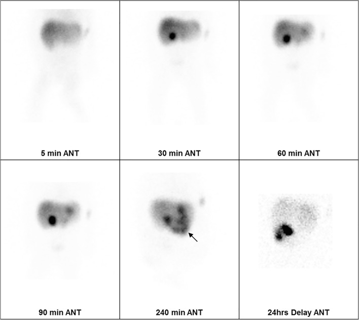 False negative hepatobiliary scintigraphy for biliary atresia pmc