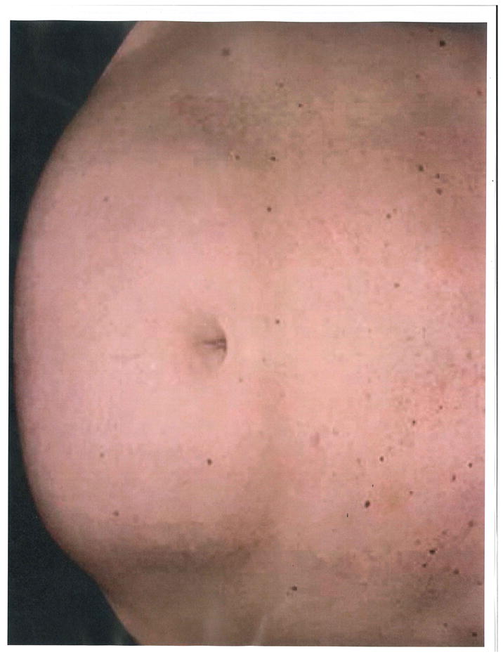 Paradoxical Adipose Hyperplasia After Cryolipolysis - PMC