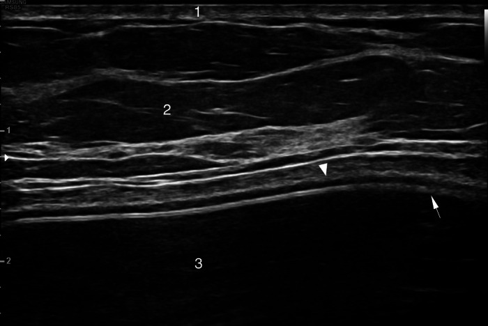 Breast Implant Seroma: A Sars‐cov‐2 Mrna Vaccine Side Effect - Pmc