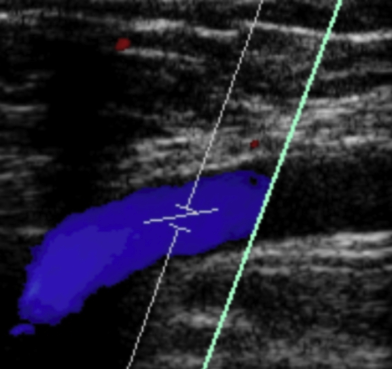 Acetabular Paralabral Cyst: An Unusual Cause of Femoral Vein ...