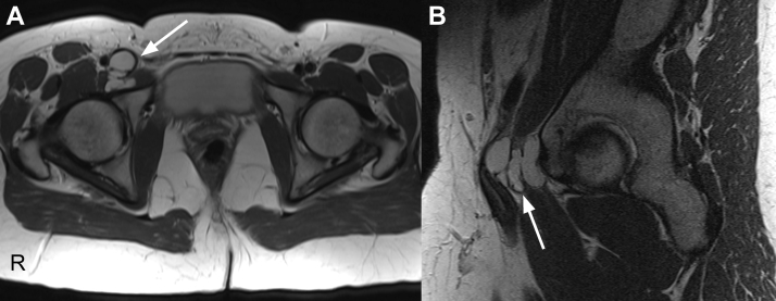 Acetabular Paralabral Cyst: An Unusual Cause of Femoral Vein ...