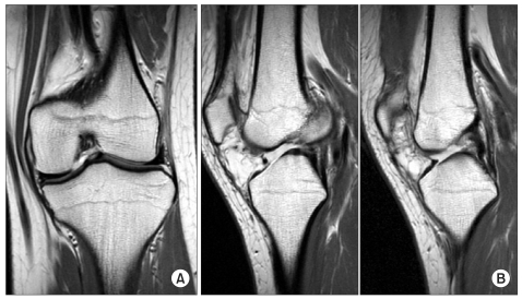 Ligament Reconstruction In Congenital Absence Of The Anterior Cruciate 