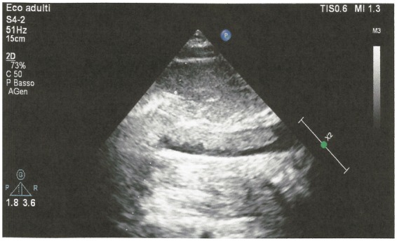 Successful Treatment With Rivaroxaban Of An Extended Deep Vein 