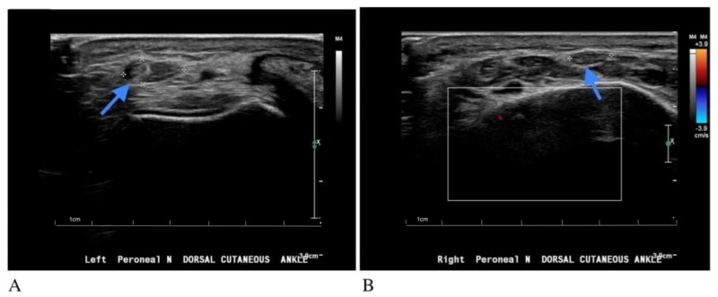 Mononeuropathy due to Entrapment of Dorsal Cutaneous Peroneal Nerve ...