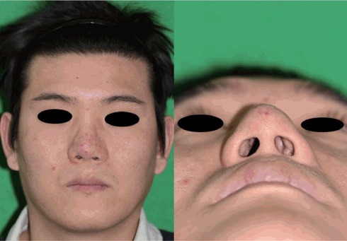 Reconstruction of the Alar-Facial Groove Using a Nasolabial Flap and ...