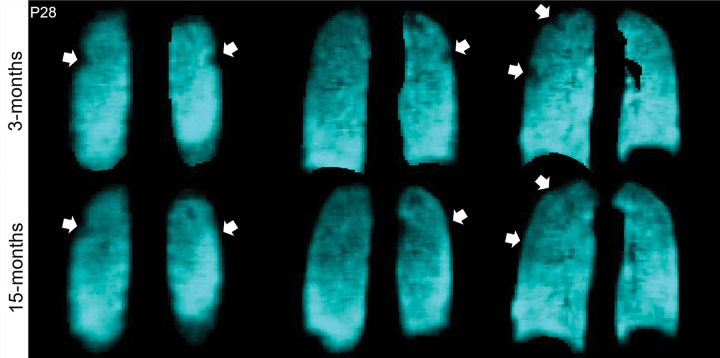 129Xe MRI ventilation scans 3 months (top) and 15 months (bottom) after COVID-19 infection in a 68-year-old woman who was hospitalized for 9 days during acute infection. Coronal 129Xe MRI scans show lung sections (cyan), with arrows indicating MRI ventilation abnormalities that improved at the 15-month follow-up. At 3 and 15 months, the forced expiratory volume in 1st second of expiration percent predicted was 84% and 100%, diffusing capacity of lung for carbon monoxide percent predicted was 81% and 91%, St George Respiratory Questionnaire score was 59 and 0, and ventilation defect percent was 2% and 0%, respectively.