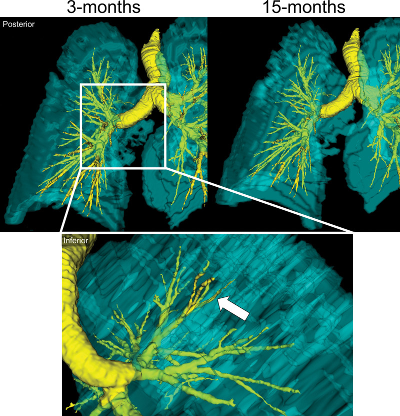 Representative images show a three-dimensional model of 129Xe MRI lung sections (cyan) and CT airways (yellow) in a 65-year-old man who was not hospitalized during acute COVID-19 infection. Top: Posterior views show ventilation abnormalities at 3 months (left), which resolved at 15 months (right). Bottom: Inset shows the inferior view, with the arrow pointing to an airway LB3 ventilation defect at 3 months.