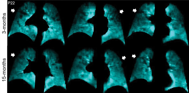 129Xe MRI ventilation scans 3 months (top) and 15 months (bottom) after COVID-19 infection in a 65-year-old man who was not hospitalized during acute infection. Coronal 129Xe MRI scans show lung sections (cyan), with arrows indicating MRI ventilation abnormalities that improved at the 15-month follow-up. At 3 and 15 months, the forced expiratory volume in 1st second of expiration percent predicted was 95% and 102%, diffusing capacity of lung for carbon monoxide percent predicted was 97% and 105%, St George Respiratory Questionnaire score was 36 and 27, and ventilation defect percent was 7% and 2%, respectively.