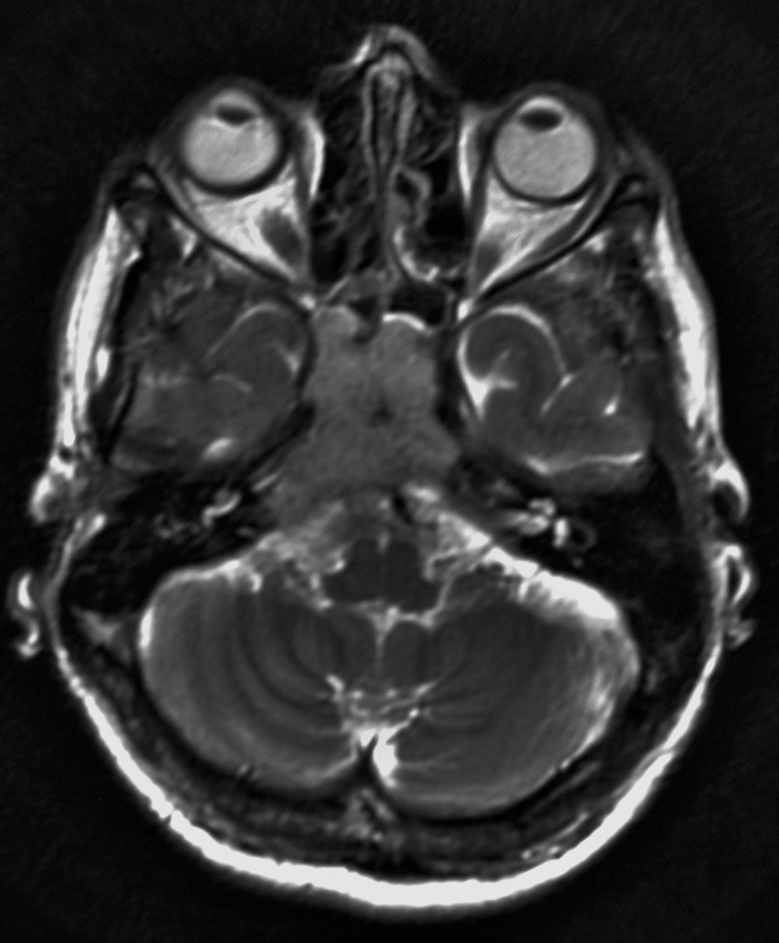 Isolated Clival Metastasis A Rare Presentation Of Renal Cell Carcinoma