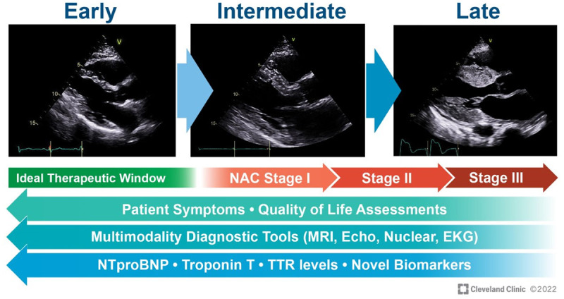 Figure 3 Echocardiogram at different levels of wall thickness in transthyretin amyloid cardiomyopathy