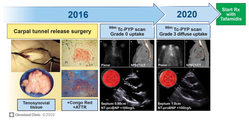 Figure 4 case of early diagnosis and treatment in asymptomatic transthyretin amyloid cardiomyopathy through proactive tissue screening