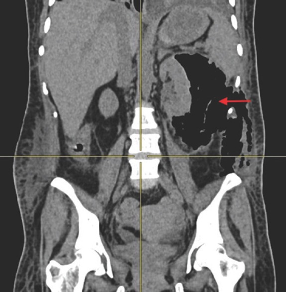 Palpable crepitus as a rare clinical presentation of emphysematous ...