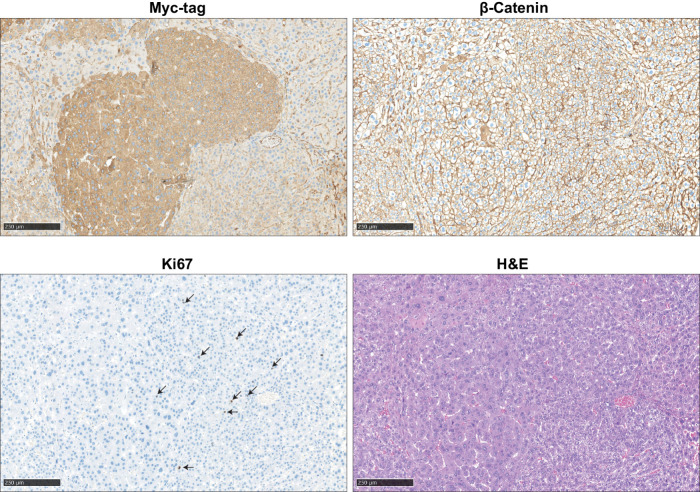 Figure 6. Immunohistochemical analysis of induced liver tumors in mice. An example is shown of two adjacent AXIN1–R395P-induced liver lesions. IHC was performed to reveal expression of transfected Myc-tagged AXIN1, endogenous location of β-catenin, and Ki67 to identify proliferating cells. Hematoxylin and eosin (H&E) staining revealed mostly slight increases in hepatocyte size and mild-to-moderate nuclear atypia. Scale bar, 250 μm.