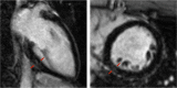Cardiac magnetic resonance image of 25-year-old healthy male complaining