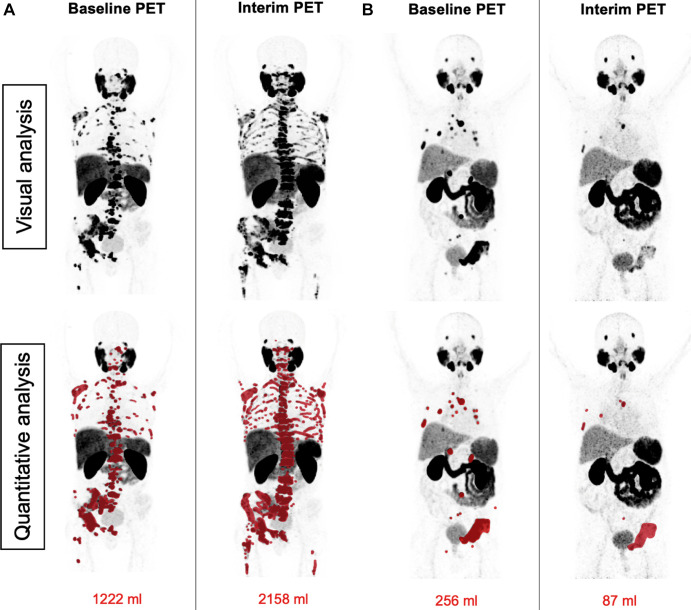 Patient examples of agreement between visual Response Evaluation Criteria in Prostate-specific Membrane Antigen (PSMA) PET/CT (RECIP) and quantitative RECIP. (A) Baseline and interim fluorine 18 rhPSMA-7.3 PET maximum intensity projection images in a 53-year-old man with metastatic castration-resistant prostate cancer previously treated with docetaxel, abiraterone, enzalutamide, and radium 223. The serum prostate-specific antigen value at baseline was 1457 ng/mL and increased after two cycles of lutetium 177 (177Lu) PSMA to 2598 ng/mL (78% increase). 177Lu-PSMA was discontinued after two cycles. All five readers detected at least one new lesion at the interim PET examination and classified this patient as having progression in PSMA-positive total tumor volume (TTV) and progressive disease (PD) according to visual RECIP. Quantitative analysis of TTV also showed progression in TTV from 1222 mL at baseline to 2158 mL at interim PET (77% increase). The tumor lesions were annotated using qPSMA software, version 1.0, and are highlighted in red on the maximum intensity projection images. Overall survival was 9.2 months. (B) Baseline and interim gallium 68 PSMA-11 PET maximum intensity projection images in a 78-year-old man with metastatic castration-resistant prostate cancer previously treated with docetaxel, abiraterone, and enzalutamide. The serum prostate-specific antigen level at baseline was 24 ng/mL and declined after two cycles of 177Lu-PSMA to 11 ng/mL (55% decrease). All five readers detected no new lesions at the interim PET examination and classified this as nonprogression in TTV and non-PD according to visual RECIP. Quantitative analysis of TTV showed a decline from 256 mL at baseline to 87 mL at interim PET (66% decrease) and non-PD according to quantitative RECIP. The tumor lesions delineated after tumor segmentation are highlighted in red on the maximum intensity projection images. A total of six cycles of 177Lu-PSMA were administered. Overall survival was 21.7 months.