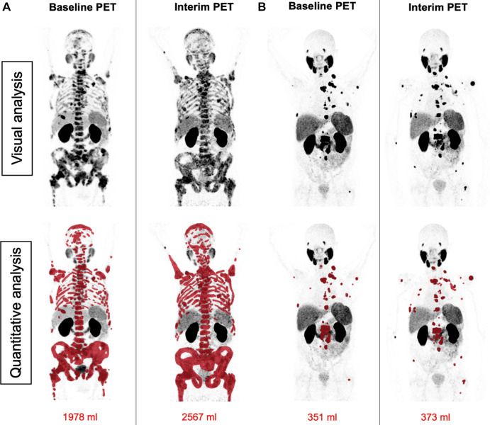 Patient examples of disagreement between visual Response Evaluation Criteria in Prostate-specific Membrane Antigen (PSMA) PET/CT (RECIP) and quantitative RECIP. (A) Fluorine 18 rhPSMA-7.3 PET maximum intensity projection images in a 77-year-old man with metastatic castration-resistant prostate cancer previously treated with docetaxel, abiraterone, and enzalutamide. The serum prostate-specific antigen level at baseline was 2547 ng/mL and declined after two cycles of lutetium 177 (177Lu) PSMA to 1866 ng/mL (27% decrease). All readers detected at least one new lesion at the interim PET examination. Three of five readers classified disease in this patient as nonprogression in PSMA-positive total tumor volume (TTV) (majority rule), which resulted in non–progressive disease (PD) according to visual RECIP. Quantitative analysis of TTV showed an increase from 1978 mL at baseline to 2567 mL at interim PET (30% increase; progression), and it was classified as PD according to quantitative RECIP. The tumor lesions were annotated using qPSMA software, version 1.0, and are highlighted in red on the maximum intensity projection images. A total of four cycles of 177Lu-PSMA were applied. Overall survival was 13.1 months. (B) Gallium 68 PSMA-11 PET maximum intensity projection images in a 69-year-old man with metastatic castration-resistant prostate cancer previously treated with abiraterone and enzalutamide and unfit for chemotherapy. The serum prostate-specific antigen level at baseline was 89 ng/mL and increased after two cycles of 177Lu-PSMA to 138 ng/mL (55% increase). All readers detected at least one new lesion at the interim PSMA PET/CT examination. Four of five readers classified this patient as having progression in TTV (majority rule), which resulted in PD according to visual RECIP. Quantitative analysis of TTV showed an increase from 351 mL at baseline to 373 mL on interim PET (6% increase; nonprogression), which resulted in non-PD according to quantitative RECIP. The tumor lesions are highlighted in red on the maximum intensity projection images. The treatment with 177Lu-PSMA was discontinued after two cycles. The overall survival in this patient was 20.5 months.