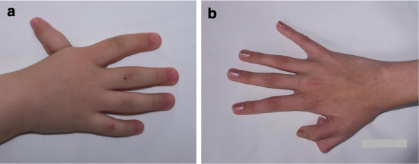 Nijmegen breakage syndrome (NBS) - PMC