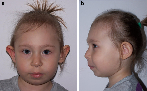 Nijmegen breakage syndrome (NBS) - PMC