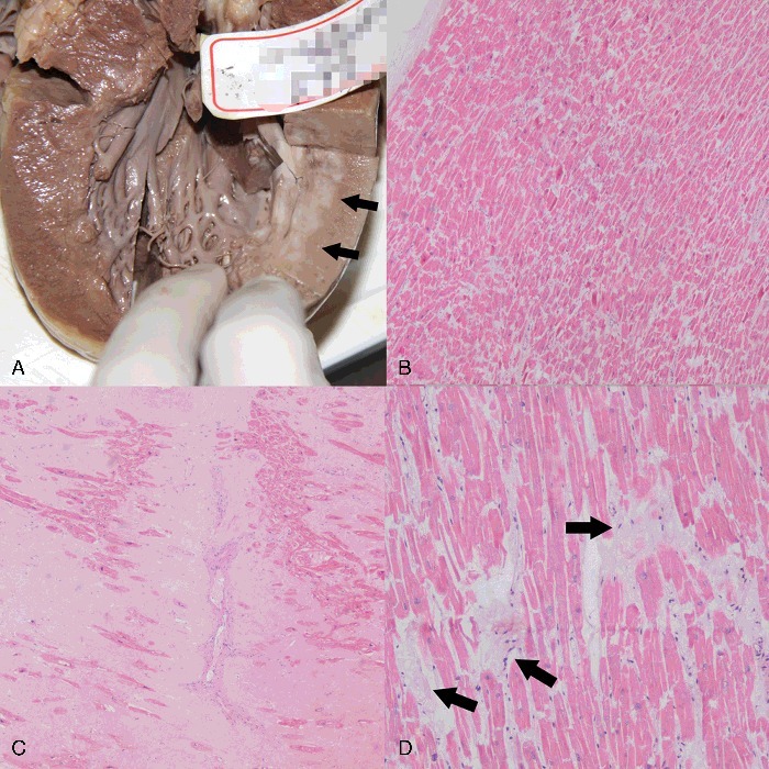 Diagnosis Of Coronary Artery Disease Using Targeted Post Mortem