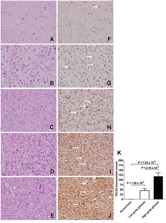 Overexpression of TELO2 decreases survival in human high-grade gliomas ...