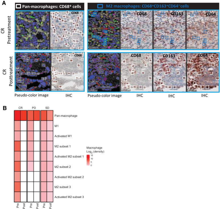 Figure 4. The effects of MTL-CEBPA treatment on TAMs in patients with HCC. A, Representative images of a CR patient's biopsies with a complete loss of protumoral M2 macrophages (blue squares: CD68+ CD163+ CD64− cells) are shown in bottom (CR posttreatment) panel when compared with top (CR pretreatment) panel. White squares represent the pan-macrophage population expressing CD68+. Pseudo-color image: created by virtual slides alignment and imported in Halo software for biomarker analysis. B, A heat map of macrophage subsets was set up based on log2 fold change between pre- and posttreatment (cell densities) samples of 3 HCC patients including the CR as shown in A, stable disease (SD), and progressive disease (PD). The macrophage populations analyzed were: pan-macrophage (CD68+ cells), antitumoral M1 macrophages (CD68+CD64+CD163−CD206− cells), activated M1 macrophages (CD68+CD64+CD163−CD206− cells), protumoral M2 macrophages subset 1 (CD68+CD163+CD64− cells), protumoral M2 macrophages subset 2 (CD68+CD206+CD64− cells), protumoral M2 macrophages subset 3 (CD68+CD163+CD206+CD64− cells), and activated M2 subsets characterized by IL10 production.