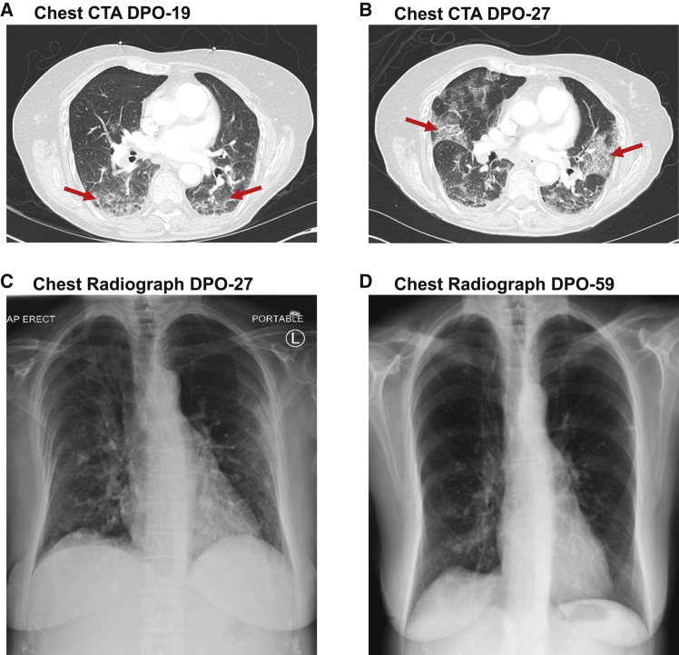 Convalescent plasma-mediated resolution of COVID-19 in a patient with ...