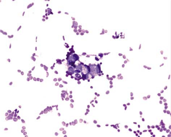 Chylous ascites and chylothorax: a case study - PMC