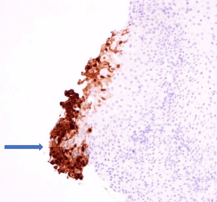 Herpes Simplex Virus Esophagitis in an Immunocompetent Patient - PMC