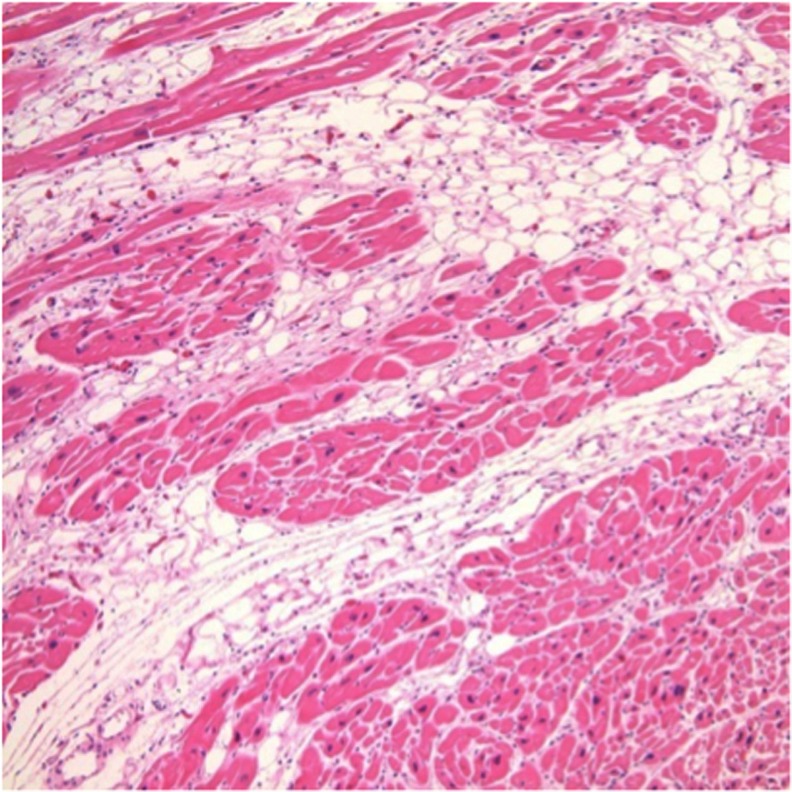 Arrhythmogenic Right Ventricular Cardiomyopathy (ARVC/D): A Systematic ...