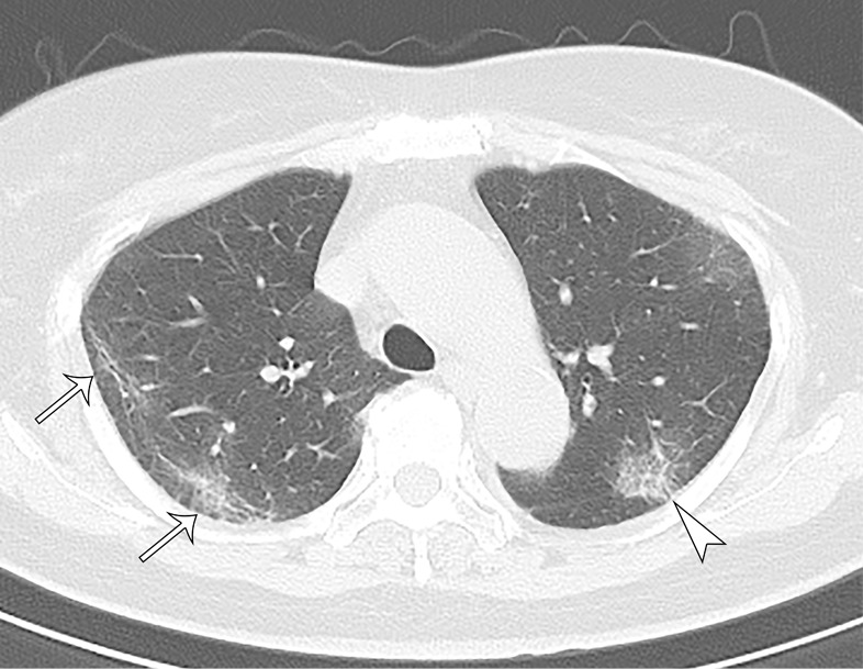 A 73-year-old asymptomatic woman. (a) On axial CT images, focal peripheral ground-glass opacities with intralobular and interlobular smooth septal thickening were shown in the left (arrowhead) and right upper lobe (arrows). The right upper lobe lesions were accompanied by subpleural curvilinear lines (arrow). (b, c) Diffuse ground-glass (reticular) opacities with consolidation with bronchiectasis and bronchial wall thickening were demonstrated in the left and right lower lobes.