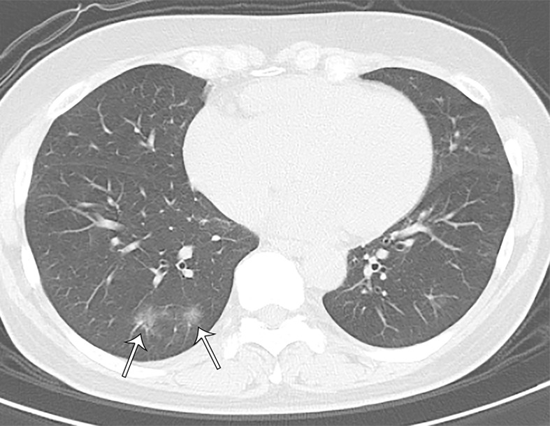 A 66-year-old asymptomatic woman. On axial CT images, focal rounded ground-glass opacities (arrows) with partial consolidation in a peribronchial and subpleural distribution were noted in the right upper (a), middle (b), and lower (c) lobes and left lower (b) lobe.