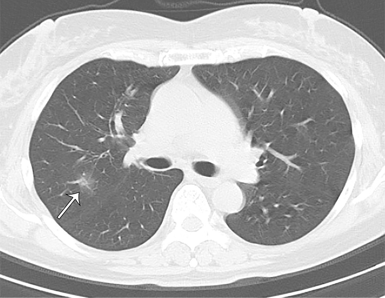 A 66-year-old asymptomatic woman. On axial CT images, focal rounded ground-glass opacities (arrows) with partial consolidation in a peribronchial and subpleural distribution were noted in the right upper (a), middle (b), and lower (c) lobes and left lower (b) lobe.