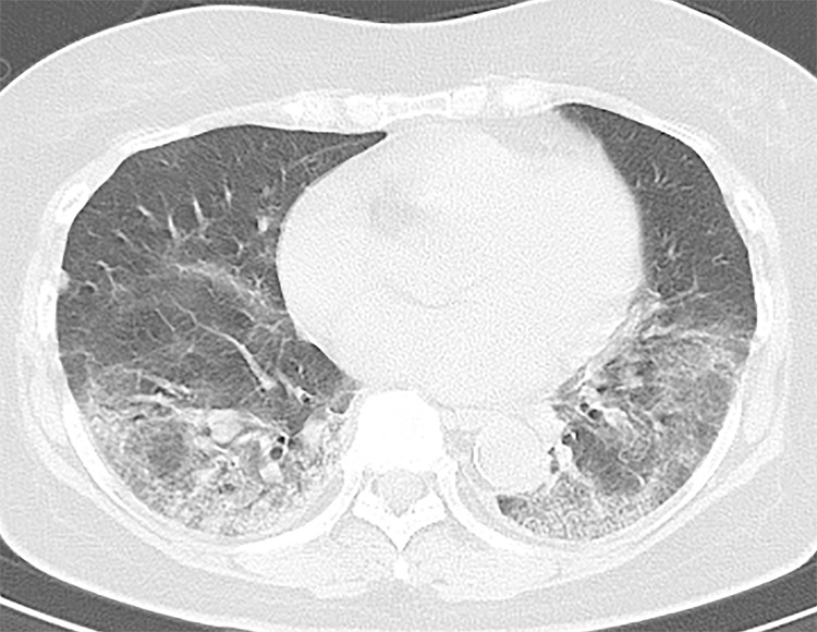 A 73-year-old asymptomatic woman. (a) On axial CT images, focal peripheral ground-glass opacities with intralobular and interlobular smooth septal thickening were shown in the left (arrowhead) and right upper lobe (arrows). The right upper lobe lesions were accompanied by subpleural curvilinear lines (arrow). (b, c) Diffuse ground-glass (reticular) opacities with consolidation with bronchiectasis and bronchial wall thickening were demonstrated in the left and right lower lobes.