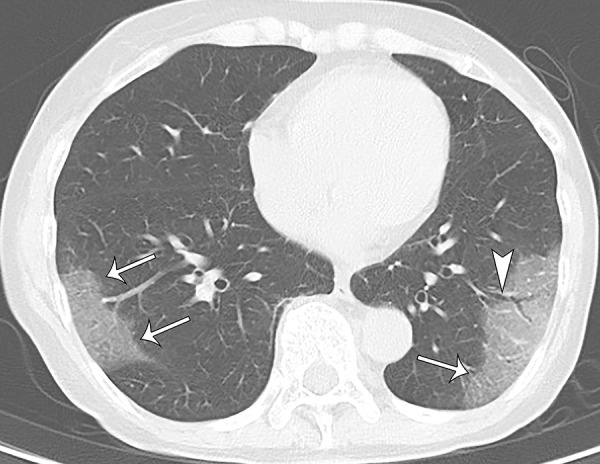 A 70-year-old asymptomatic woman. On axial CT image, focal subpleural ground-glass opacities with smooth intralobular and interlobular septal thickening were demonstrated in the right and left lower lobes (arrows). The left lower lobe lesion was accompanied by air bronchogram with mild bronchial dilatation (arrowhead).