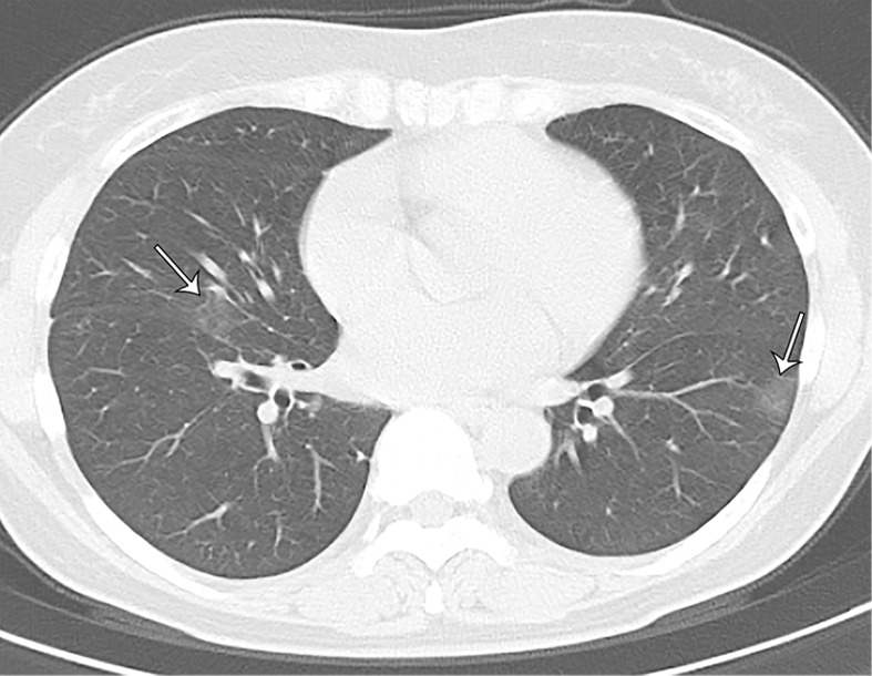 A 66-year-old asymptomatic woman. On axial CT images, focal rounded ground-glass opacities (arrows) with partial consolidation in a peribronchial and subpleural distribution were noted in the right upper (a), middle (b), and lower (c) lobes and left lower (b) lobe.