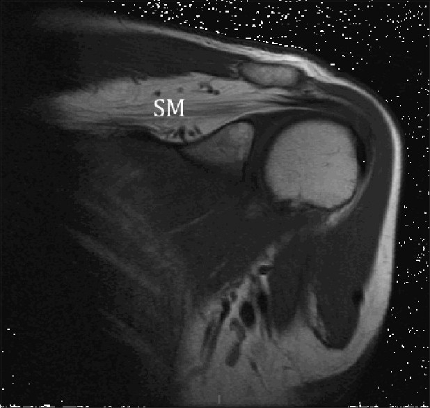 Isolated supraspinatus muscle atrophy and fatty infiltration associated ...