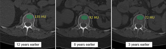 Individual example demonstrates the potential for CT-based fracture prediction. (a) Transverse nonenhanced CT images from a 59-year-old asymptomatic woman undergoing colonography for colorectal cancer screening. Automated bone (63 HU) and muscle (−1.7 HU) attenuation were at the 99th and 98th percentiles, respectively, relative to the screening study cohort, but Fracture Risk Assessment Tool scores of 6.7% (any fracture) and 0.5% (for hip fracture) were well below the recommended treatment threshold. However, she suffered a left femoral neck fracture only 3 months later. (b) The patient had multiple prior nonenhanced CT examinations for urolithiasis over the years, which in retrospect demonstrated progressive decrease in L1 bone attenuation (as shown). Unfortunately, this information is typically not yet considered in routine clinical practice for CT examinations performed for other indications.