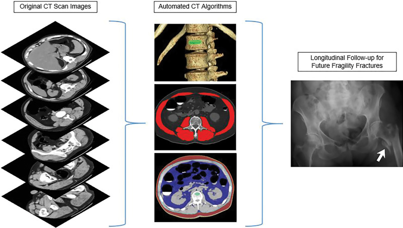 Depiction of the fully automated CT imaging biomarker tools used to assess bone, muscle, and fat from the original abdominal CT scan data. In practice, one can review the visual tool outputs to allow for quality assurance of the automated segmentation results in individual patients. CT biomarkers results were then correlated with subsequent fragility fractures.