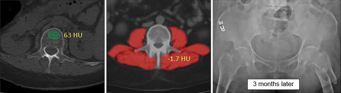 Individual example demonstrates the potential for CT-based fracture prediction. (a) Transverse nonenhanced CT images from a 59-year-old asymptomatic woman undergoing colonography for colorectal cancer screening. Automated bone (63 HU) and muscle (−1.7 HU) attenuation were at the 99th and 98th percentiles, respectively, relative to the screening study cohort, but Fracture Risk Assessment Tool scores of 6.7% (any fracture) and 0.5% (for hip fracture) were well below the recommended treatment threshold. However, she suffered a left femoral neck fracture only 3 months later. (b) The patient had multiple prior nonenhanced CT examinations for urolithiasis over the years, which in retrospect demonstrated progressive decrease in L1 bone attenuation (as shown). Unfortunately, this information is typically not yet considered in routine clinical practice for CT examinations performed for other indications.