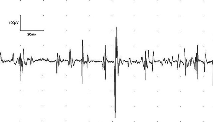 Two case reports of distal upper limb weakness following influenza-like ...