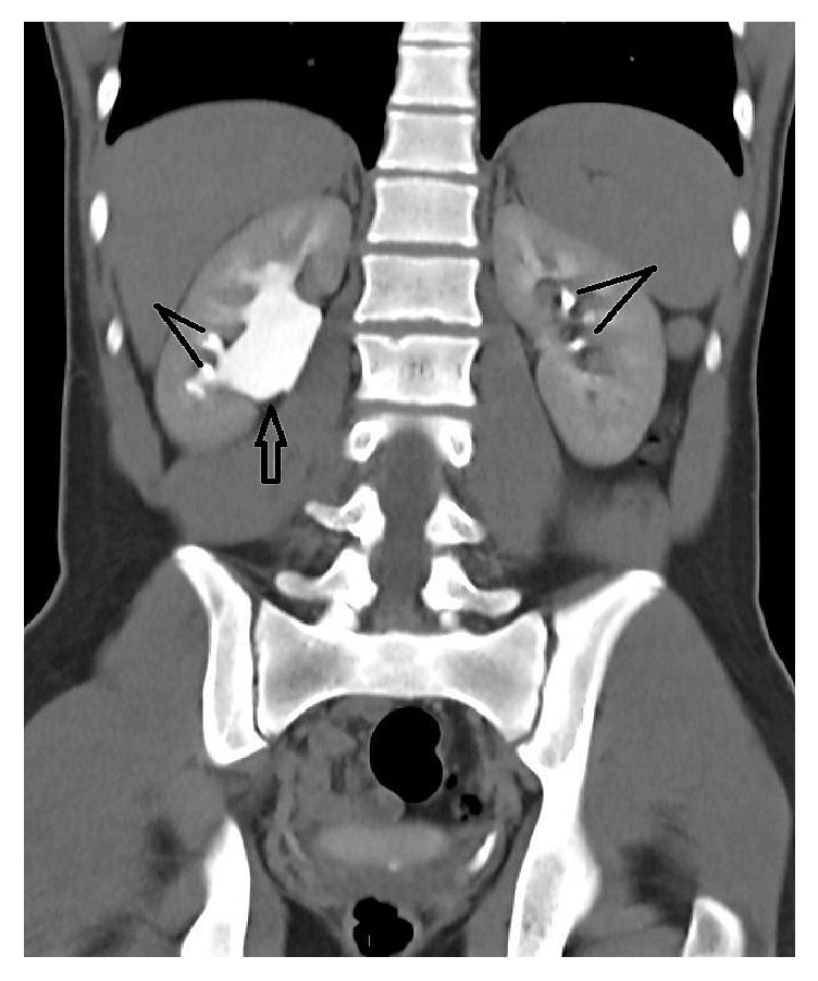 Ureteropelvic junction obstruction and parathyroid adenoma coincidence