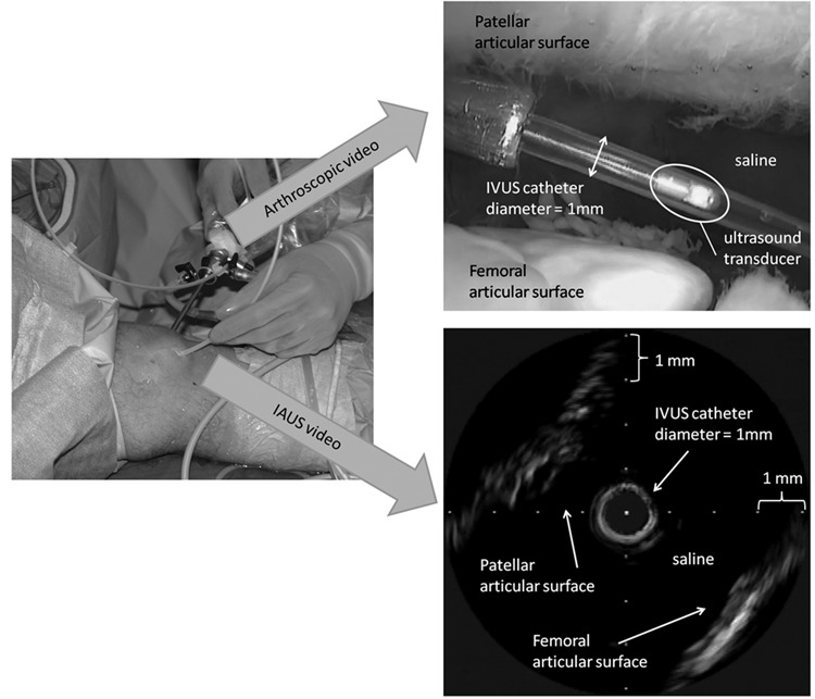 Arthroscopic Ultrasound Assessment of Articular Cartilage in the Human ...