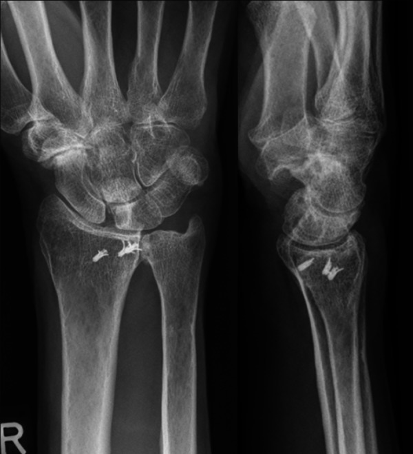 Scaphocapitolunate Arthrodesis and Radial Styloidectomy: A Treatment ...