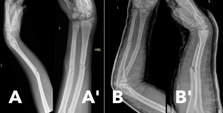 Conservative Management of a Forearm Refracture With the Titanium ...