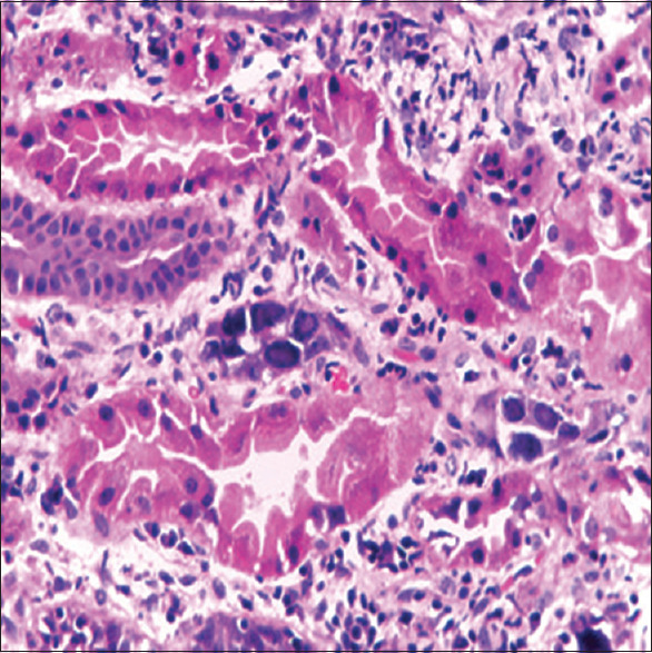 a-rare-cause-of-encephalopathy-post-renal-transplant-bk-polyoma-virus
