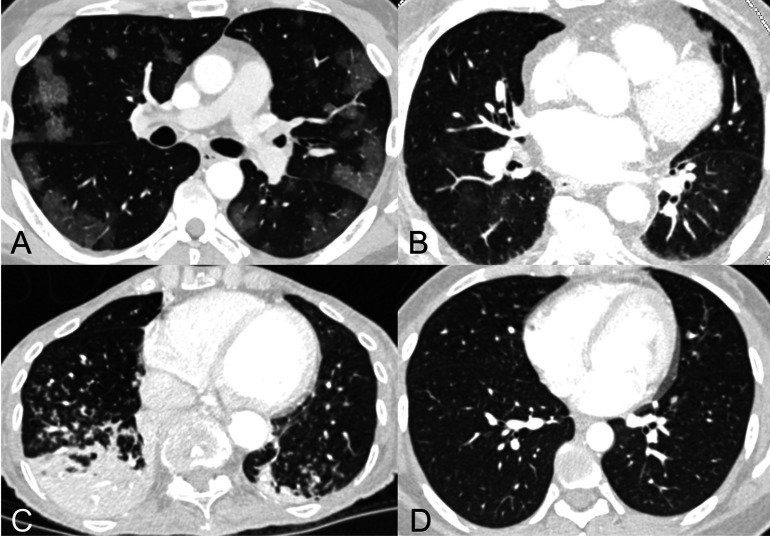 Examples of cases assigned the same RSNA consensus COVID-19 category by all readers.A) “Typical” category assigned to CT of 53-year-old man with COVID-19 pneumonia who presented after 2 weeks of cough, congestion, and fevers. Axial CT image shows multiple ground glass opacities with a peripheral predominance bilaterally, many with a round morphology.B) “Indeterminate” category assigned to CT of 82-year-old woman who presented with fever, exertional dyspnea, palpitations, and chest pain, with 2 PCRs negative for SARS-CoV-2. Axial CT image shows a small amount of ground glass opacity with a central predominance in the perihilar regions bilaterally.C) “Atypical” category assigned to CT of a 79-year-old woman who presented with fever, productive cough, dyspnea, and hypoxemia; 2 PCRs were negative for SARS-CoV-2. Axial CT image shows tree-in-bud nodules and consolidation in the lower lobes bilaterally, a pattern suggesting aspiration/pneumonia.D) “Negative for pneumonia” category assigned to CT of a 30-year-old woman who presented with one week of dry cough, sore throat, and severe fatigue; 2 PCRs were negative for SARS-CoV-2. Axial CT image shows a normal appearance of the lungs. Final diagnosis of symptoms was attributed to recurrent rheumatic myopericarditis within the context of her history of juvenile rheumatoid arthritis.